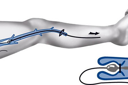 сафенектомія в Дейлі Медікал