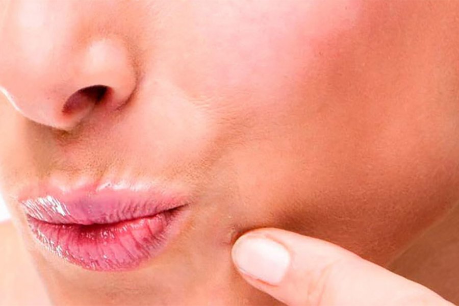 как избавится от папиллом