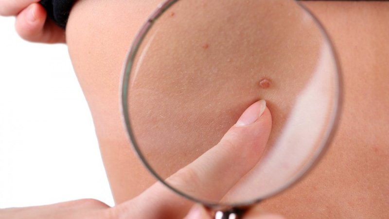 как удалять папилломы