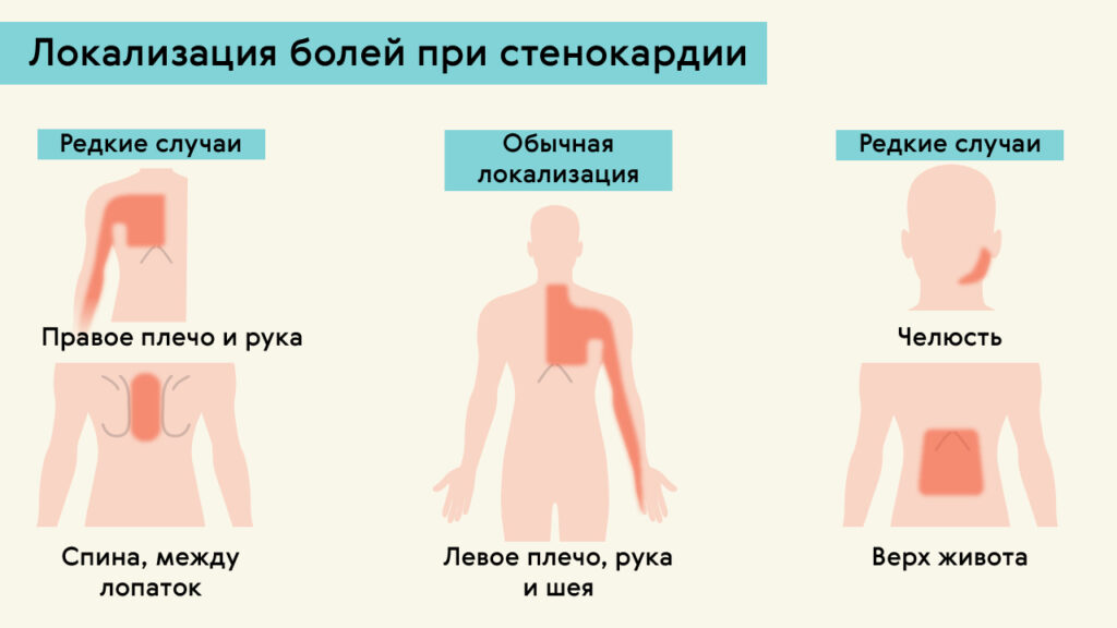 где болит при стенокардии