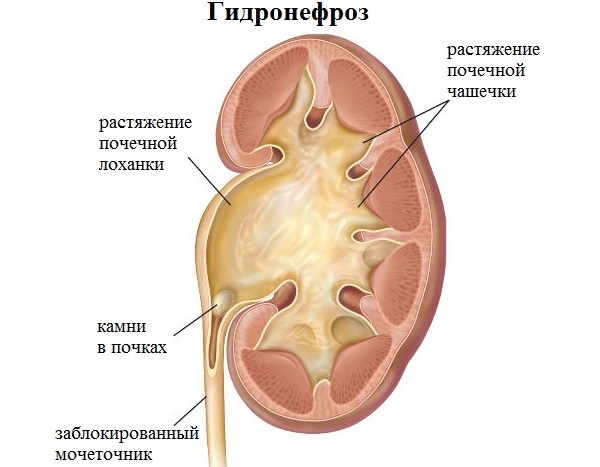 что такое гидронефроз
