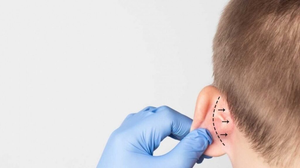 отопластика операция