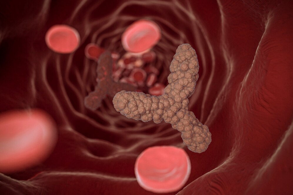 атеросклероз